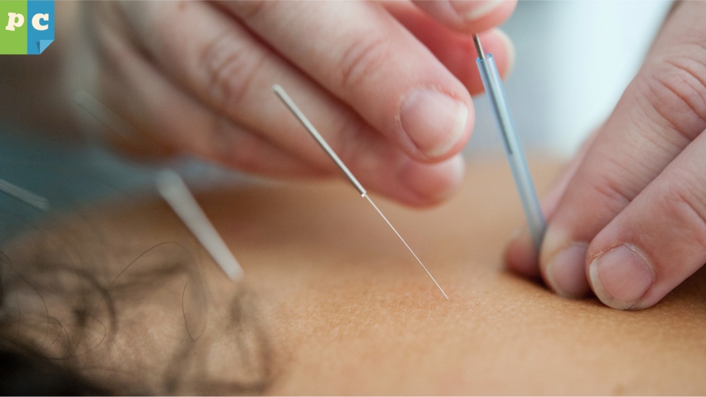 Bild zur pro und contra Liste Akupunktur